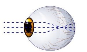 myopia before retina